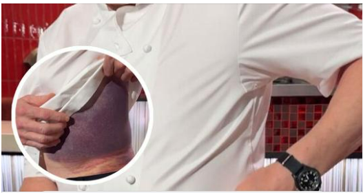 “I’m Lucky To Be Here”: Gordon Ramsay Flooded With Recovery Wishes After Harrowing Accident