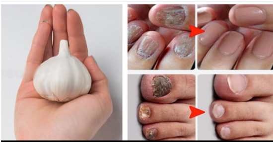 Erase Nail Fungus Naturally: Discover the Power of Garlic 