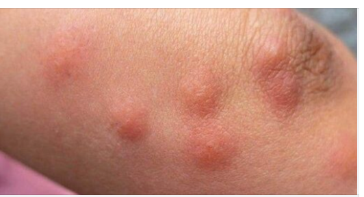 Mosquito Bites: Quick and Easy Relief with a Time-Tested Solution