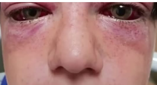 Playground craze leaves 11-year-old boy “looking like an alien” 