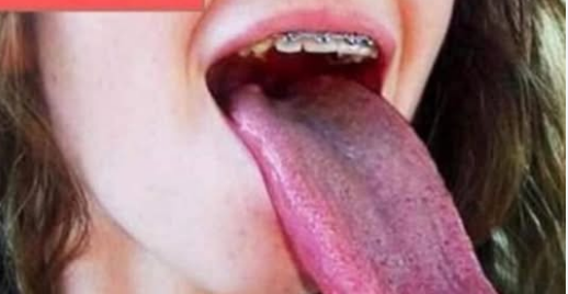 What White Tongue Is, and What to Do About It