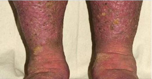 How Your Feet Could Be Signaling Heart Problems and Clogged Arteries