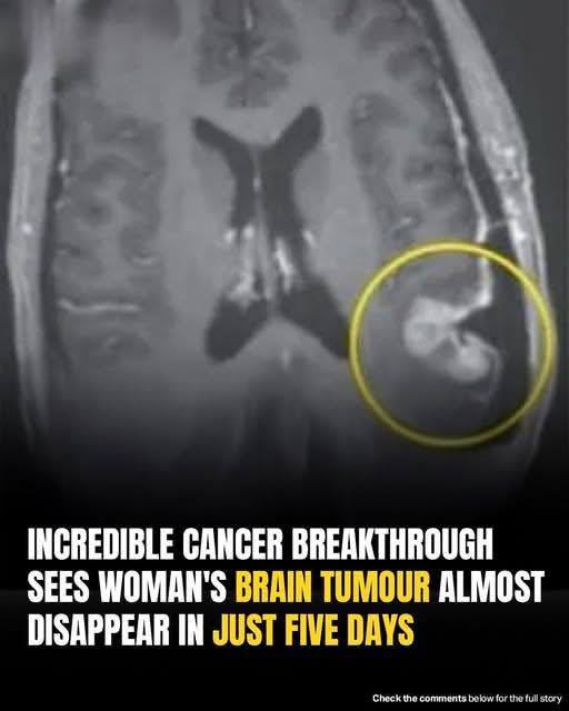 Woman’s inoperable tumor shrinks within five days following breakthrough cancer treatment