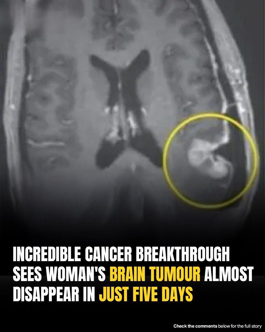 Womans Inoperable Brain Tumor Shrinks In Just Five Days Thanks To Cancer Breakthrough!