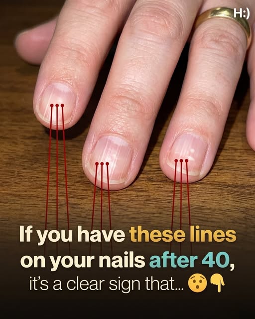 Why Vertical Lines on Your Nails Often Appear With Age