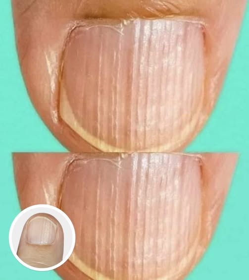 If you have these lines on your nails after 40, it is a clear sign that..