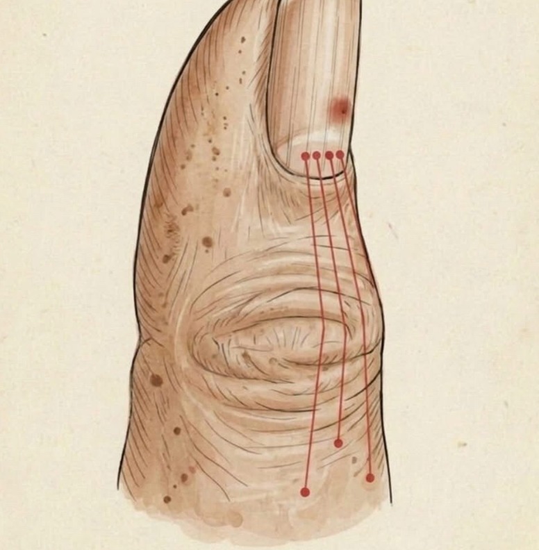If You Have These Lines on Your Nails, You Should Pay Attention: Experts Explain That Changes in Nail Texture, Such as Ridges or Lines, Can Sometimes Reflect Normal Aging, Minor Injury, or Nutritional Factors, but Persistent or Sudden Changes May Also Signal Underlying Health Conditions—Highlighting the Importance of Monitoring Nail Health and Seeking Medical Advice if Unusual Signs Persist
