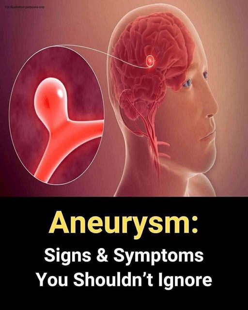 12 signs that may signal a brain aneurysm — Don’t ignore them