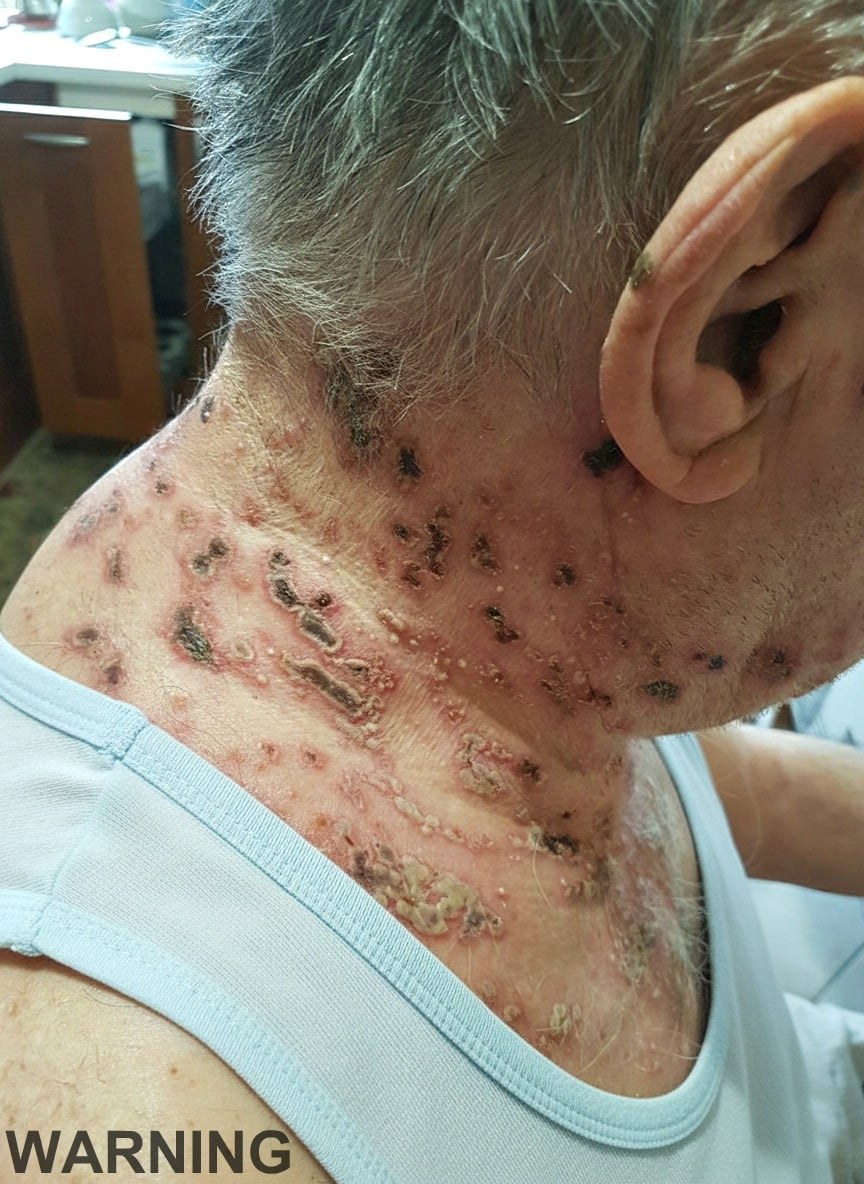 This is the silent disease that is triggered when you come into contact with …