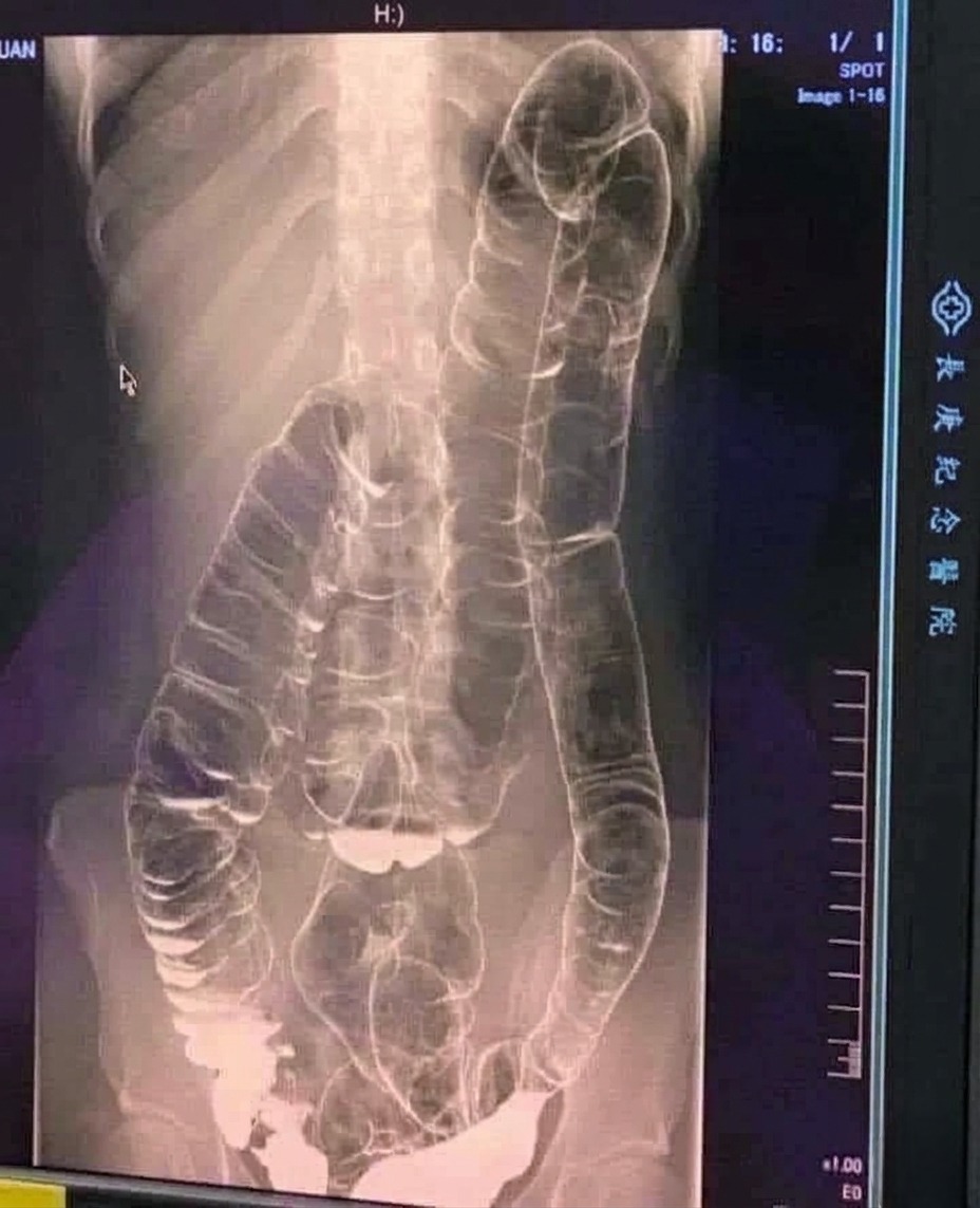 Severe Constipation and Toxic Megacolon: Causes and Solutions Explores How Chronic Digestive Problems, Inflammation, Infections, Medication Effects, or Underlying Medical Conditions Can Lead to Dangerous Colon Enlargement, While Experts Explain Warning Signs, Possible Complications, Treatment Options, and the Importance of Prompt Medical Care to Prevent Serious Health Risks and Support Safe Digestive Function Over Time