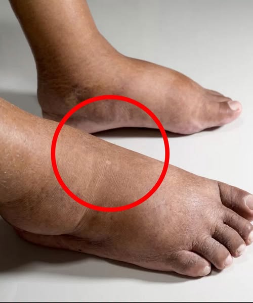If You Notice Your Legs Are Swollen, Doctors Warn It Could Be a Sign of a Serious Underlying Condition That Many People Overlook Until It Becomes Dangerous. What Seems Like a Simple Change in Your Body May Actually Be Linked to Circulation Problems, Fluid Retention, or Other Health Issues That Should Never Be Ignored Without Proper Medical Attention Immediately