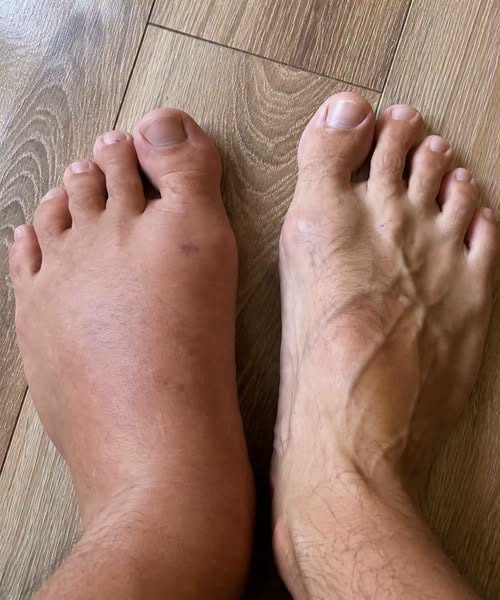 Swollen Feet and Ankles: Common Causes, Simple Care Tips, and When to Seek Advice