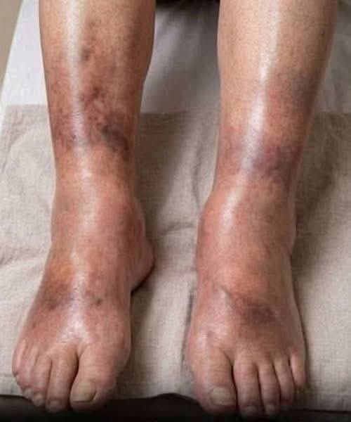 The silent signal: What your swollen legs may reveal about pancreatic cancer