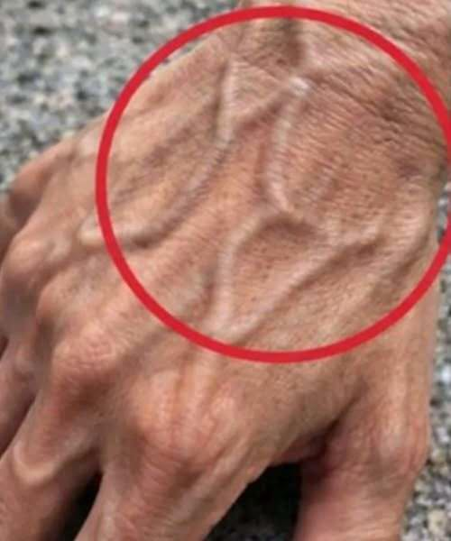 What Bulging Veins Can Mean