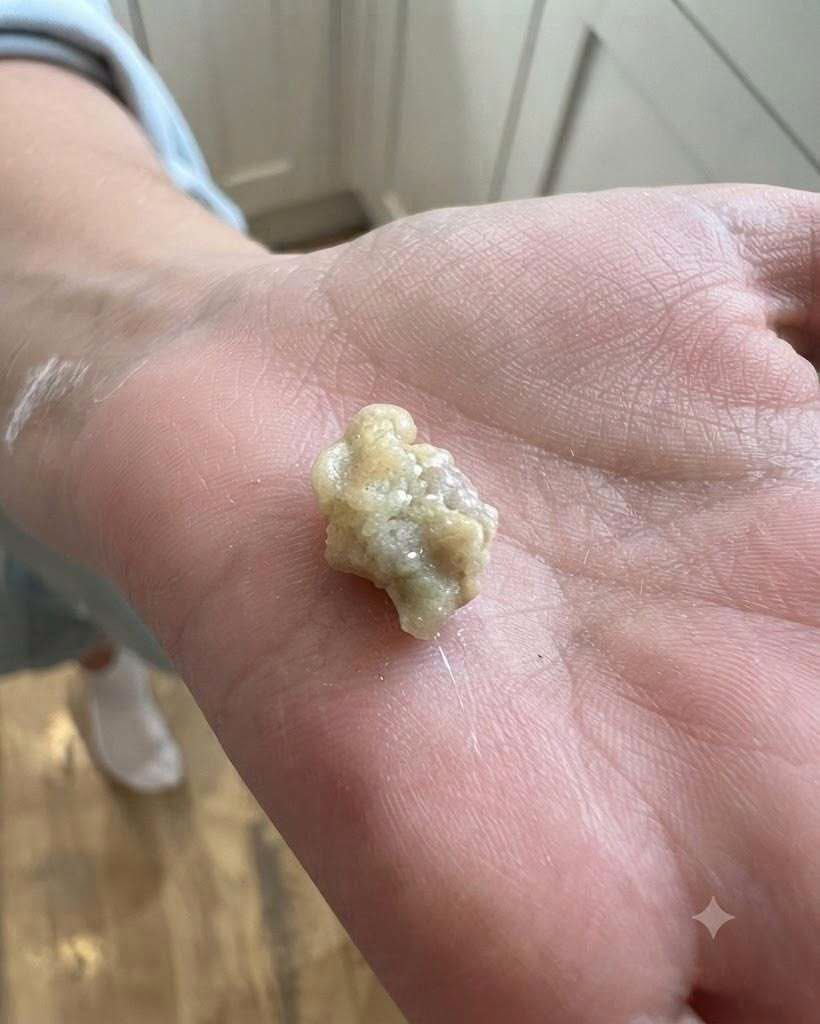 Here’s what you need to know about tonsil stones – the weird pimple-like growths in your throat
