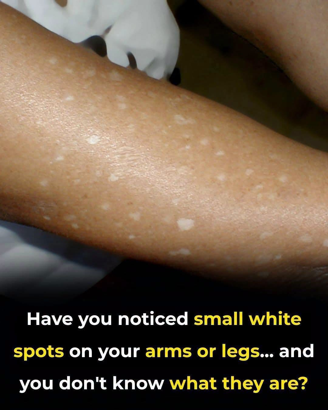 What Vitamin Deficiencies May Lead to White Spots on the Skin
