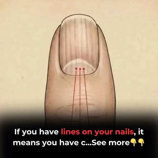 If You Have These Lines on Your Nails, You Should Pay Attention: Experts Explain That Changes in Nail Texture, Such as Ridges or Lines, Can Sometimes Reflect Normal Aging, Minor Injury, or Nutritional Factors, but Persistent or Sudden Changes May Also Signal Underlying Health Conditions—Highlighting the Importance of Monitoring Nail Health and Seeking Medical Advice if Unusual Signs Persist