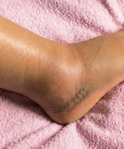 Swollen Legs: Understanding the Symptoms, Causes, and Treatments