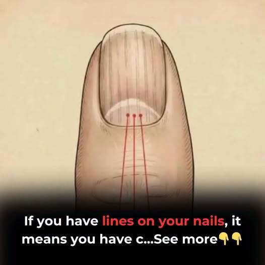 If you have these lines on your nails after 40, it is a clear sign that..