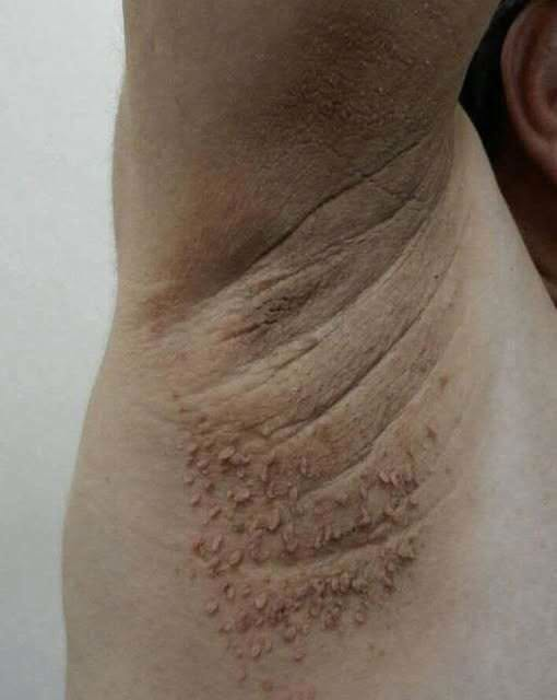The Shocking Secret Behind Dark Neck Patches: The Deadly Health Warning Hiding on Your Skin