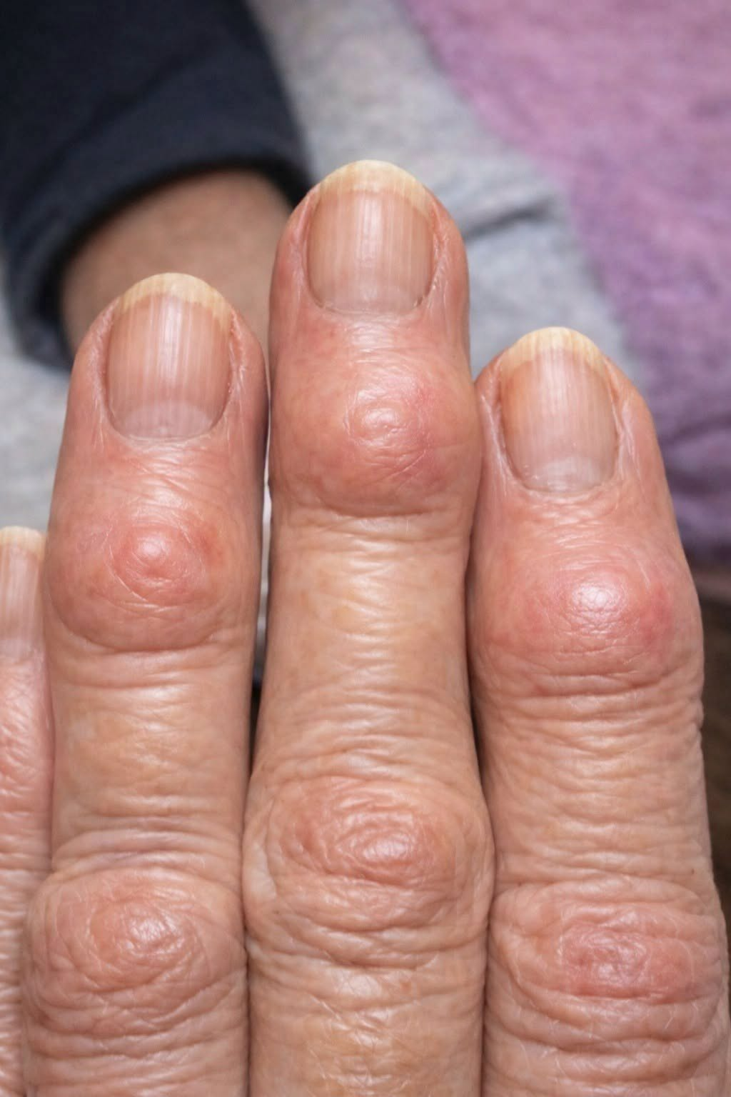 The Terrifying Truth Behind the Mysterious Hard Bumps Spreading Across Your Hands