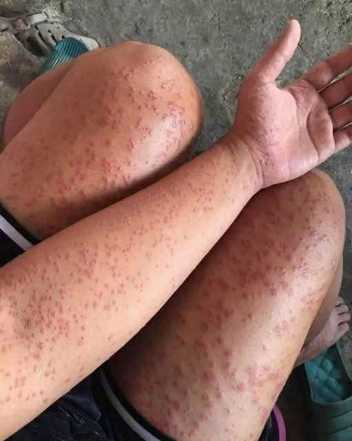 I slept at my friend’s old apartment for a couple days noticed these weird bump…
