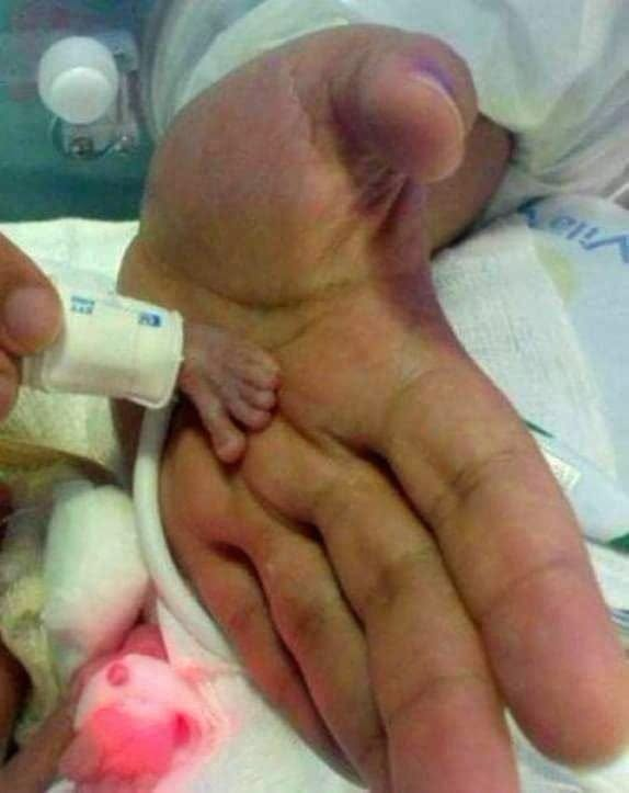 One of the smallest babies in the world was born!