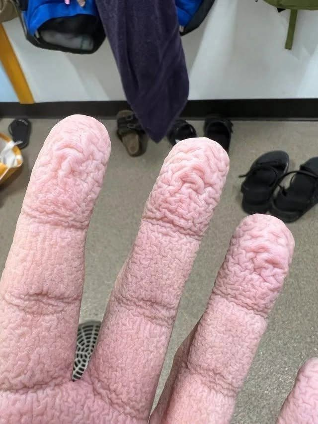 Wrinkled Fingers After Water Exposure: The Shocking Biological Truth Behind Your Skin’s Creepy Reaction