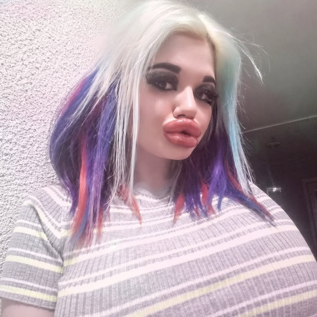 Woman Pursues “Biggest Lips in the World” After 27 Procedures