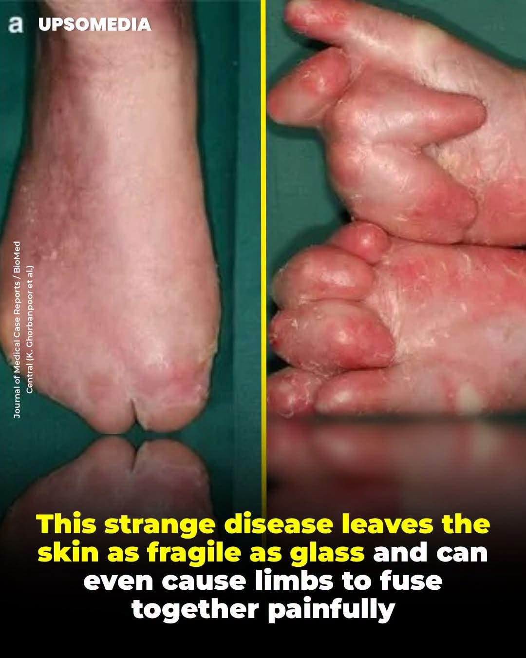 Epidermolysis bullosa is a hereditary condition that makes the skin as fragile as glass. This disease is characterized by the lack of key proteins that act as glue between the layers of the skin, so even minimal friction from clothing or a hug can cause blisters and deep wounds. There are different levels of severity, ranging from milder scarring to scarring that can cause the fusion of the fingers or toes, or even internal complications that make swallowing impossible.  This content is for informational purposes only and does not replace medical consultation.