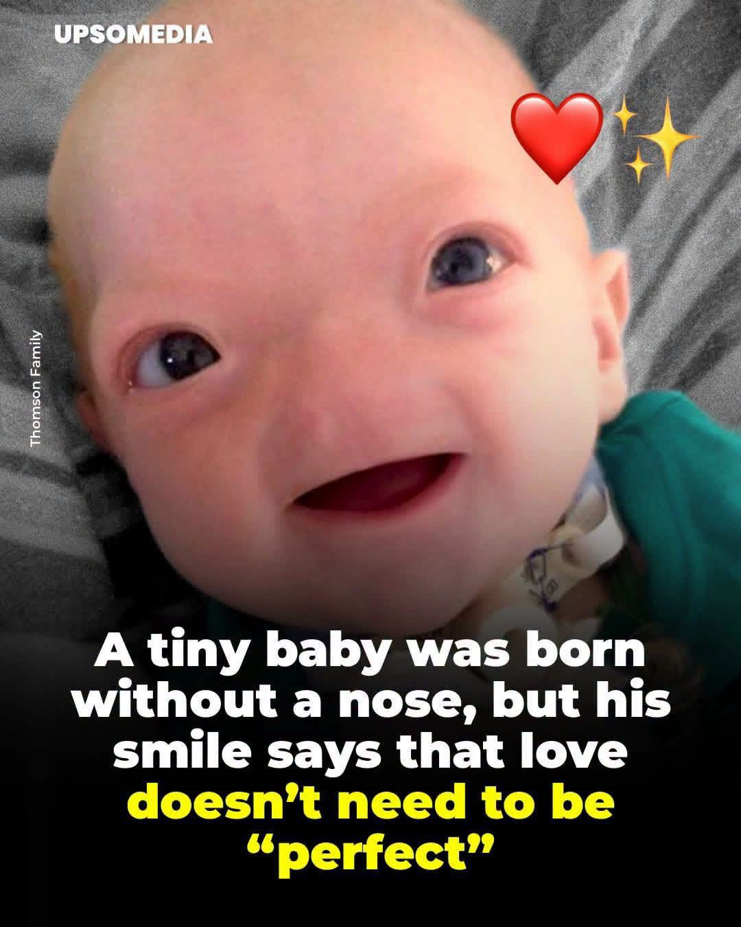 When Eli came into the world, the doctors were left speechless: the little one was born with congenital arhinia, a condition so rare (1 in 197 million) that he had no nose or nasal cavities. But while science saw an extreme medical case, his family saw an absolute miracle. They decided not to subject him to unnecessary plastic surgeries just to “fit in”, embracing his unique beauty. Eli gave us an immense light, showing with his unbreakable smile that true love knows nothing of beauty standards. Although his time in this world was brief, his legacy of unconditional love and courage forever transformed the hearts of millions. 