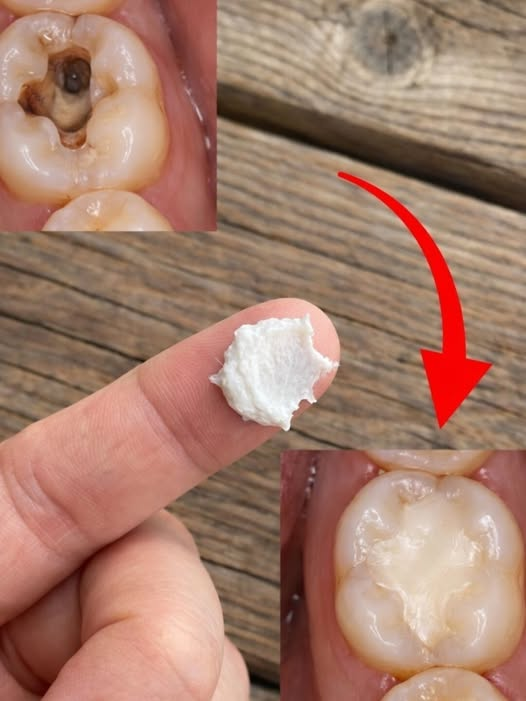 5 Simple Natural Home Remedies to Help Prevent Cavities and Support Healthy Teeth, and Why Small Daily Habits Often Matter More Than Expensive Products When It Comes to Protecting Your Smile for the Long Term