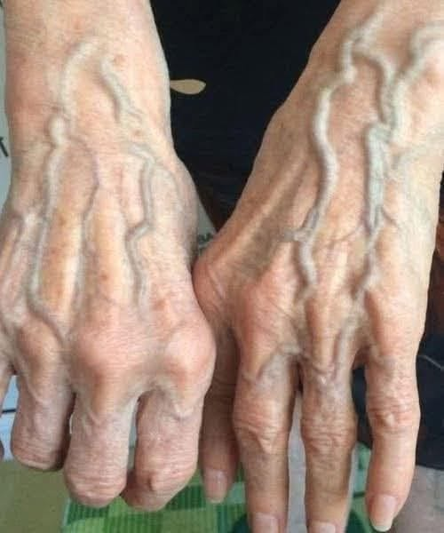 When to Worry About Veins That Appear Out of Nowhere