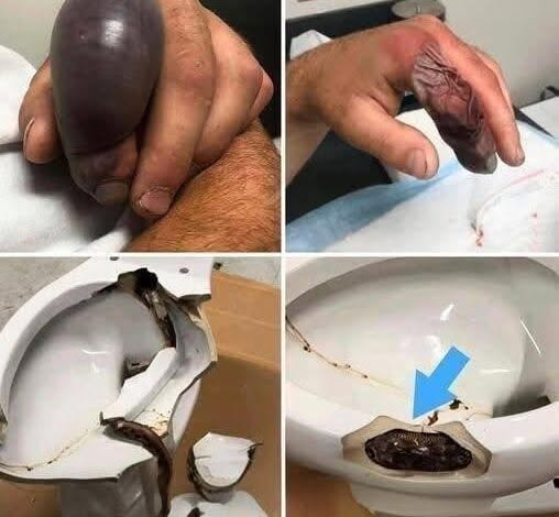 He Sat Down Like Any Other Day Then Something From The Toilet Changed His Life Forever